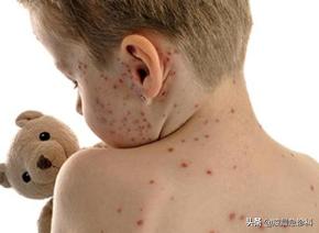 宝宝长水痘怎么处理好得快,小孩子水痘要是没发好会怎么样