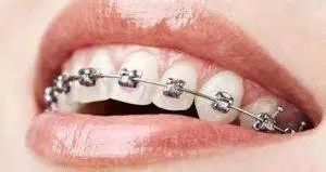 大龄牙套,成年人牙齿矫正隐形牙套过程视频