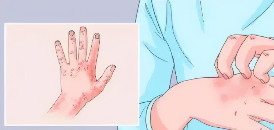 荨麻疹很痒忍下来有用吗,荨麻疹实在太痒了可以输液缓解嘛