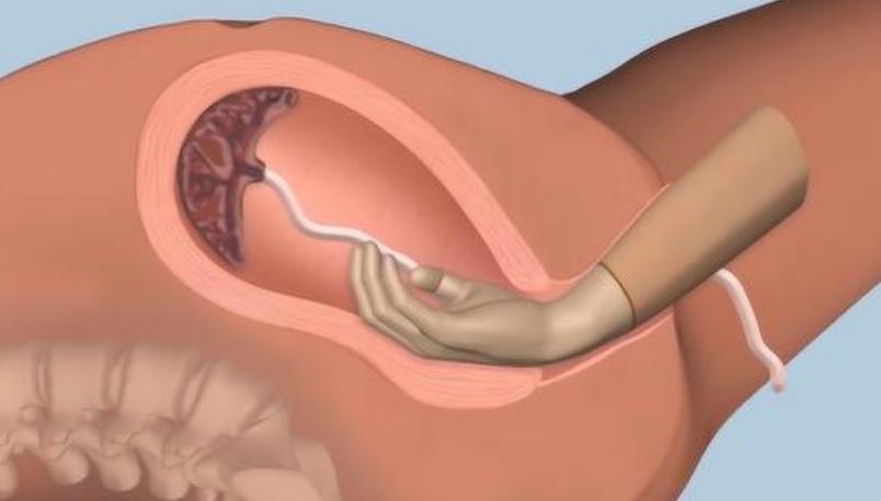 生产时怎样才会手剥胎盘,孕妇生产手剥胎盘