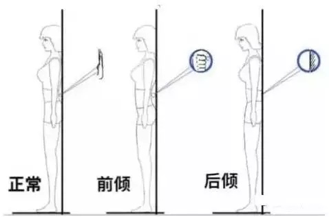 如何改善驼背和骨盆前倾,怎样改善骨盆前倾的腰疼