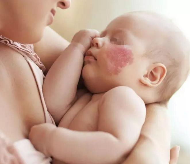 鲜红斑痣越长越大该怎么办?