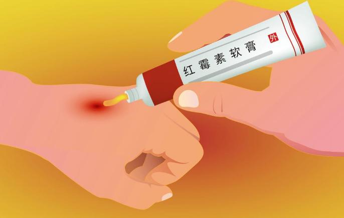 红霉素软膏在眼部涂,红霉素软膏除了涂眼还能涂哪里