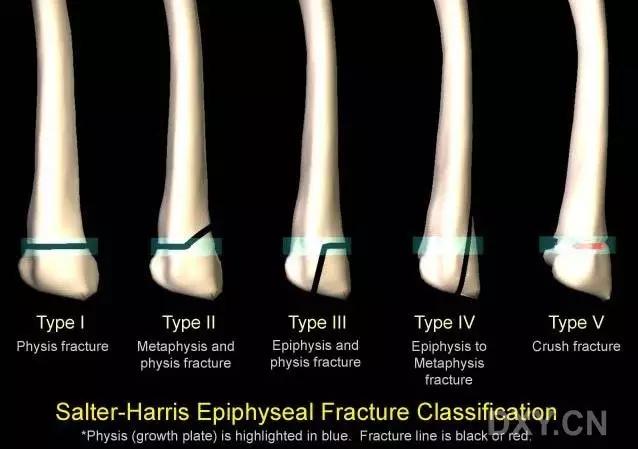 特殊骨折类型,特殊骨折体征