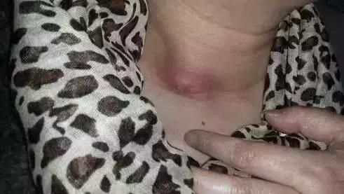 卡鱼刺在喉咙吃醋有用吗,吃鱼刺卡到的急救方法