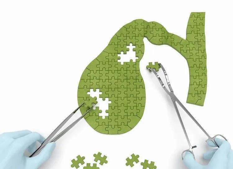 小孩胆结石可以做取石保胆手术吗,胆囊炎胆结石可以做保胆取石术吗