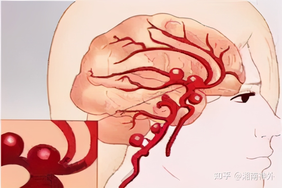 脑动脉瘤的定时炸弹,颅内定时炸弹
