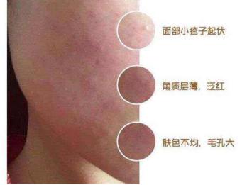 激素脸是怎么形成的,激素脸是怎么引起的呢