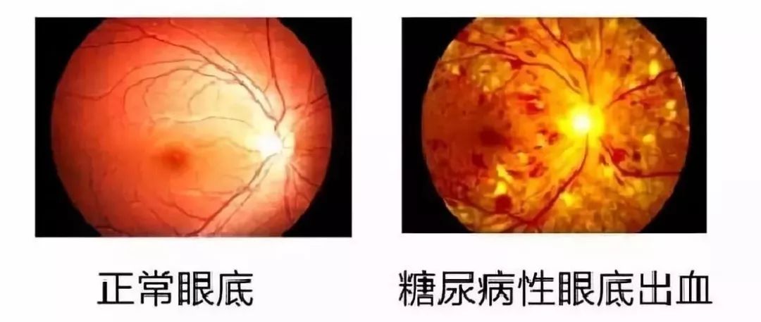 视力模糊眼底出血什么原因,视力下降中医病名