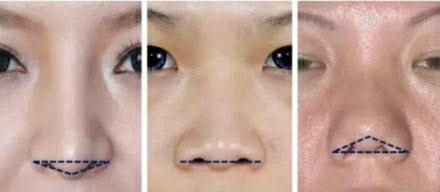 塌鼻好看的明星,哪些明星的鼻子是蒜头鼻和塌鼻子