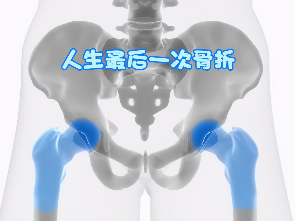 人生最后一次骨折有必要手术吗,人生的最后一次骨折指哪个部位