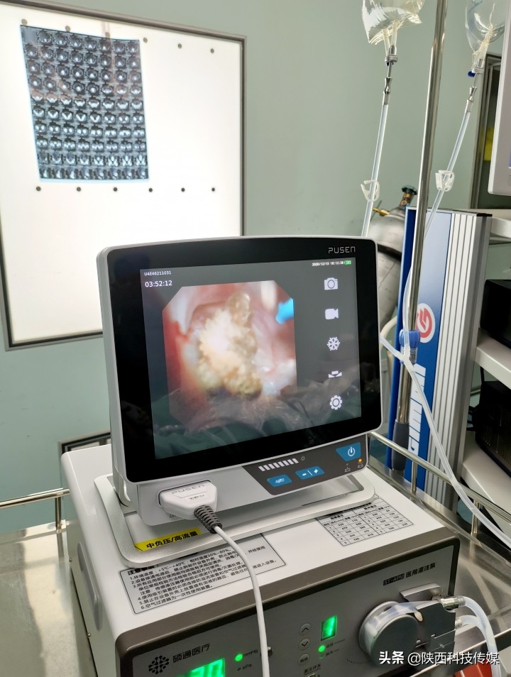 软镜经尿道钬激光碎石,洞口县人民医院输尿管软镜碎石术