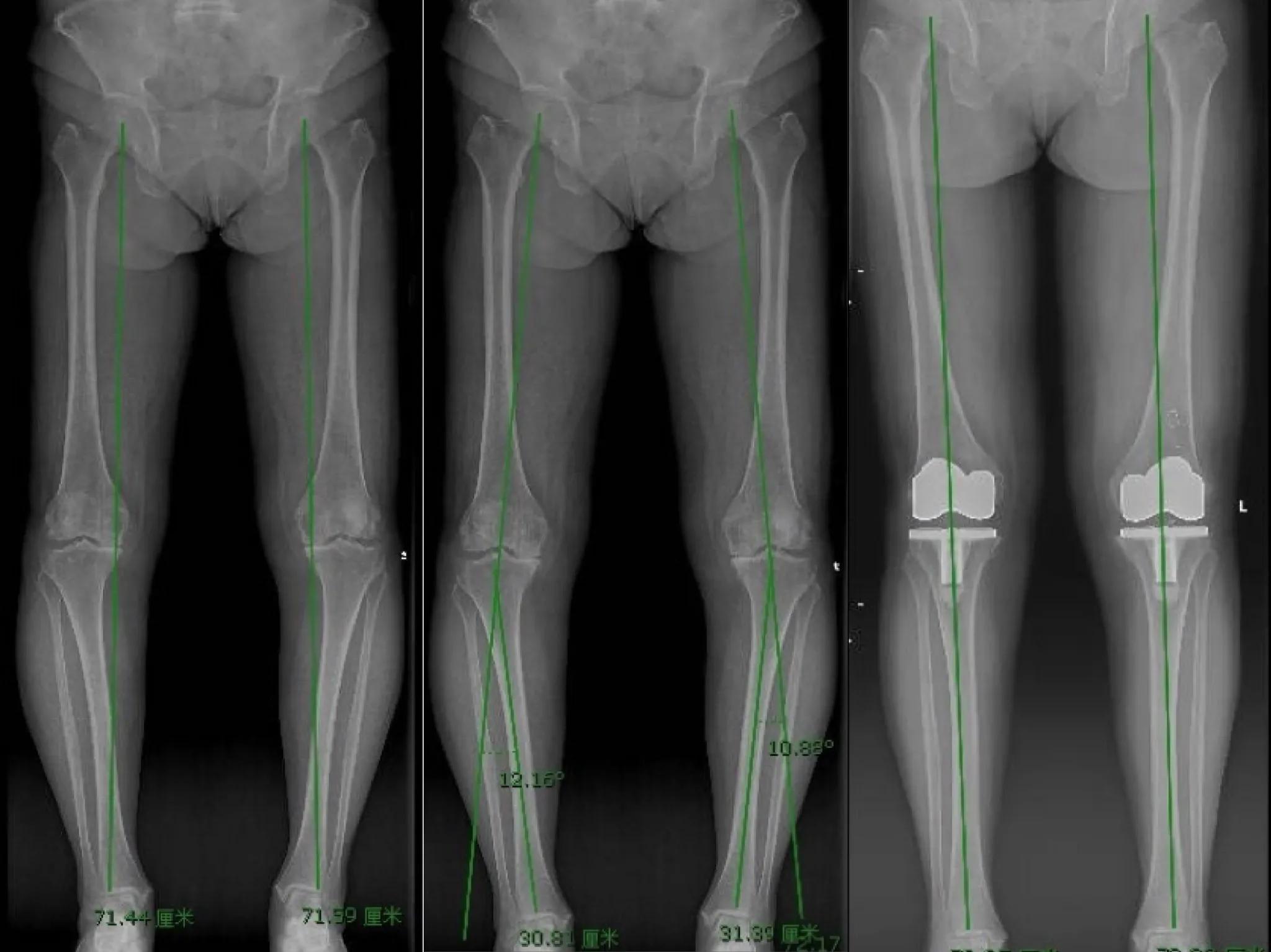 膝关节骨关节炎并内翻畸形如何选择治疗方案？