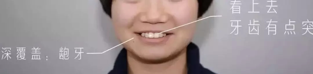 深覆盖vs深覆合,深覆盖和深覆合哪个难度大