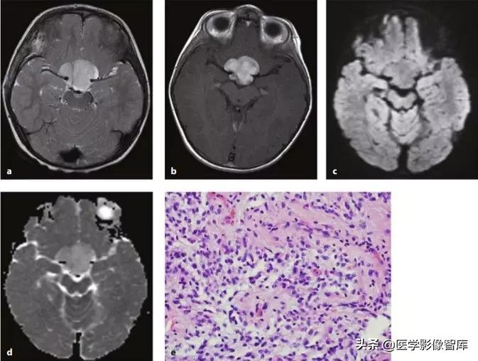 双侧额叶皮层区dwi偏高是什么意思,颅内dwi高信号病变