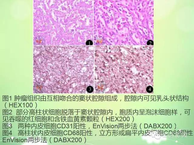 脾血管瘤中医辨证,脾血管瘤超声表现
