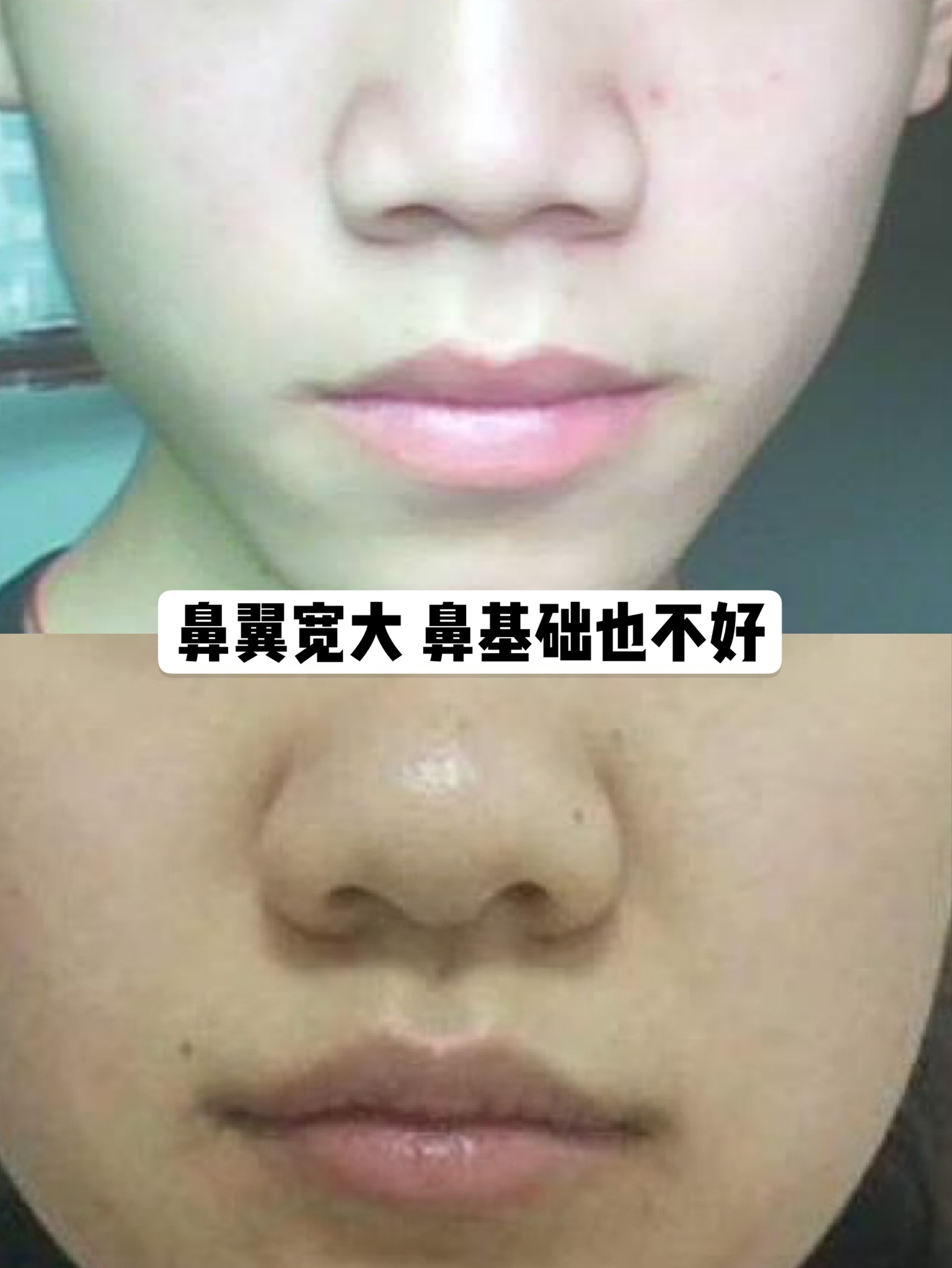 鼻翼缩小可以单独做吗,鼻翼缩小可以内切吗