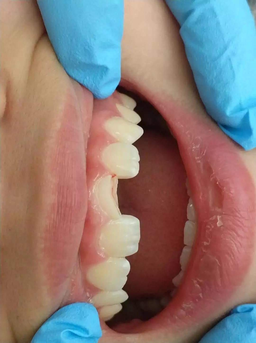 疫情期间怎么做好口腔防护,防控疫情口腔注意事项