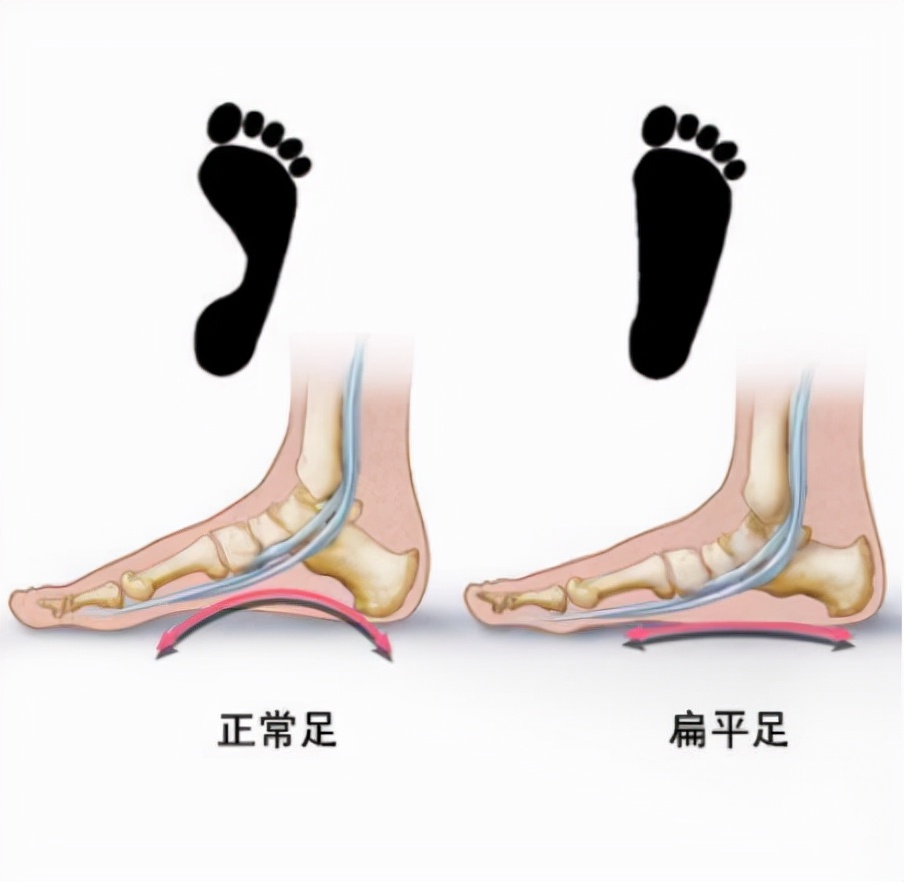 肥胖可能导致平足吗,肥胖真的能让人变矮吗