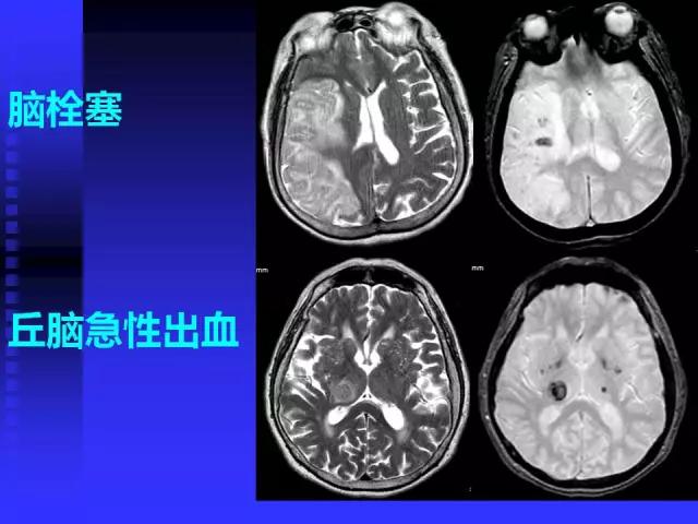 头颅mri读片视频教程,颅脑mri读片入门教程视频讲解全集