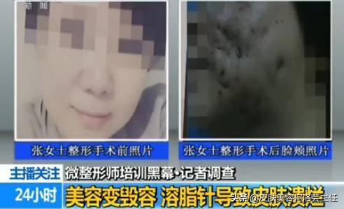 溶脂针一针能瘦身吗,瘦手臂溶脂针多少钱一针会反弹吗