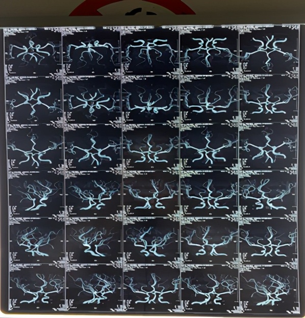 头晕耳鸣听力下降,头晕脑胀听力下降怎么回事