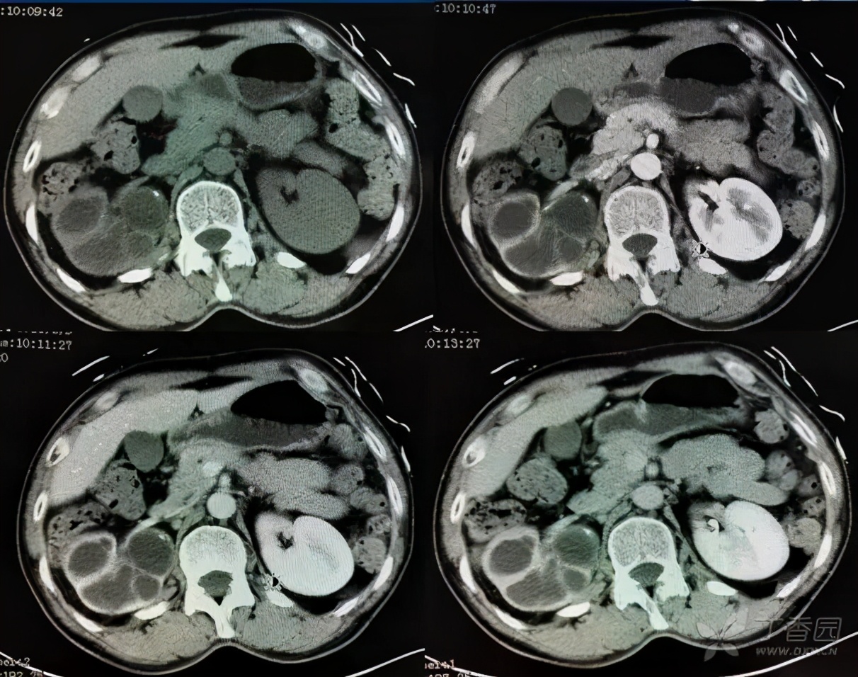 除了肺结核其他结核怎么筛查,肾结核导致泌尿系统全部感染结核