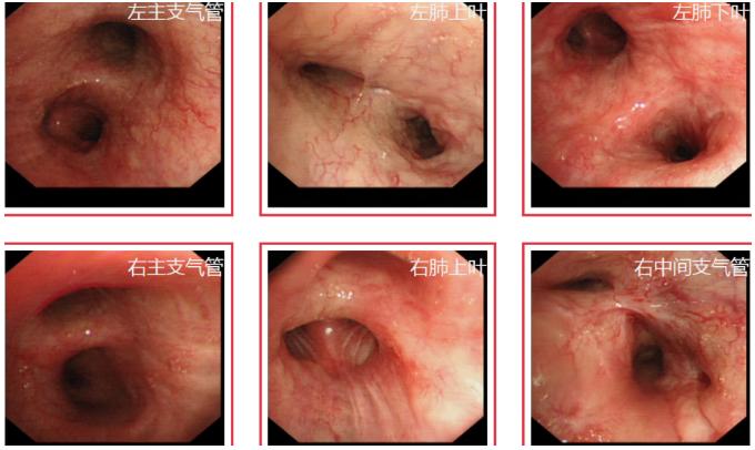 鍖荤敓鏃犳硶鍒ゆ柇缁撹妭鐥呰繕鏄粨鏍哥梾,鏈夎偤缁撴牳鐥呭彶鍗佸嚑骞存煡鍑鸿偤缁撹妭