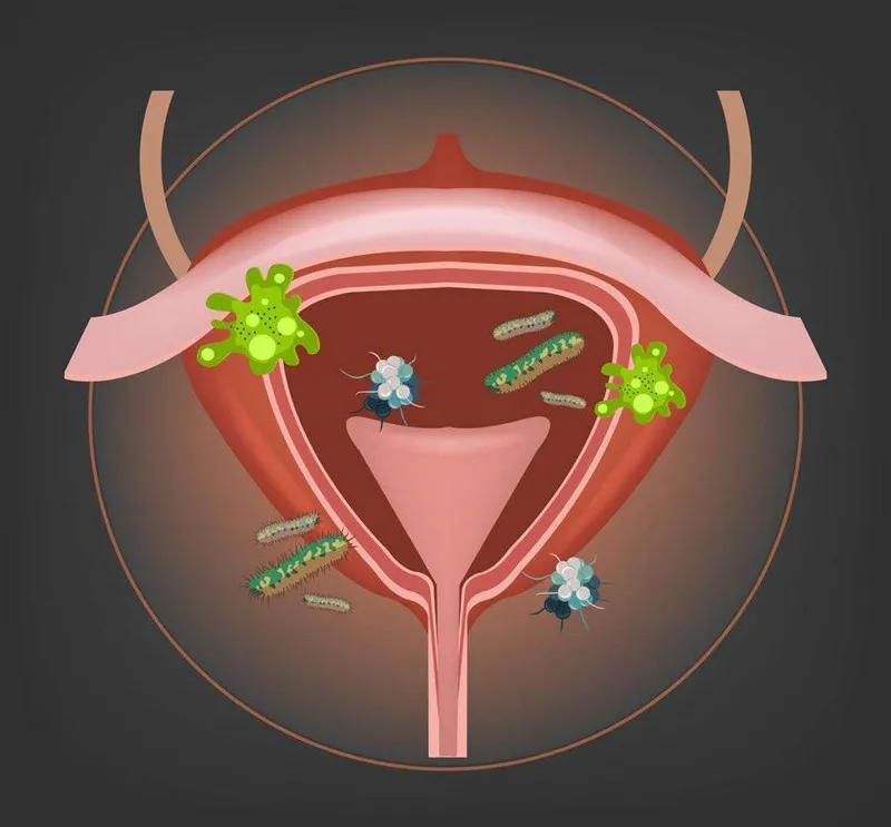 怀孕了怎么预防和治疗妇科炎症,臭氧治疗妇科炎症会影响怀孕吗