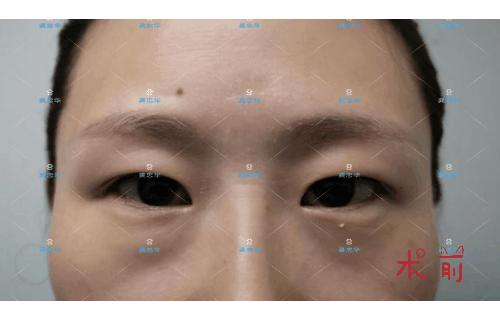 眼皮松弛可以做埋线双眼皮吗,埋线双眼皮眼皮松弛了该怎么办