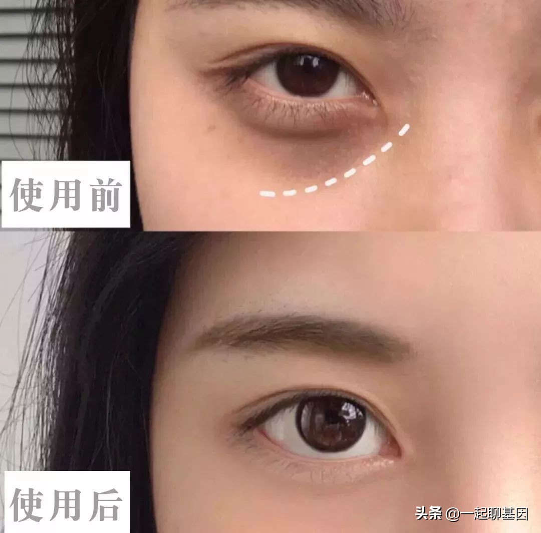 大眼袋眼纹抹平了,眼纹医美怎么去除
