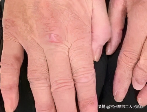 得了皮肌炎,挂号是挂皮肤科?