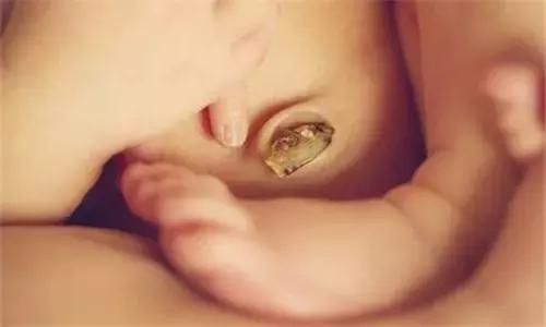 新生儿脐带一个月还没脱落正常吗,新生儿脐带一个月还没掉正常吗