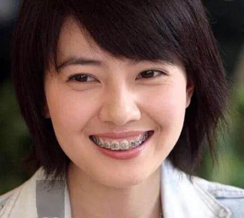 你与颜值和健康之间只差一个牙套,你与颜值巅峰只差一个发际线