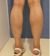 跑步小腿变粗案例,跑步杀人案真实案件