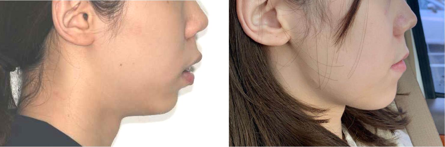 华晨宇的下巴,削下颌骨的华晨宇