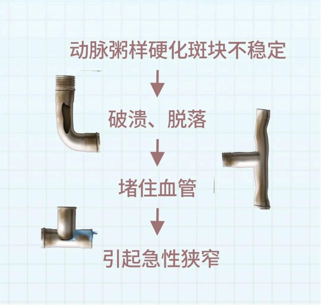 神经内科韩璐医师：脑血管狭窄一定要放支架吗？不一定