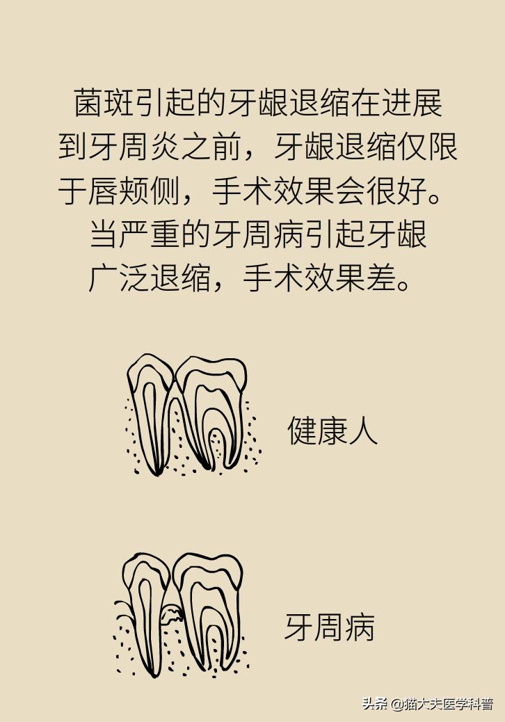 牙根露出来怎样修复不动刀,牙根暴露但没疼痛感怎么办