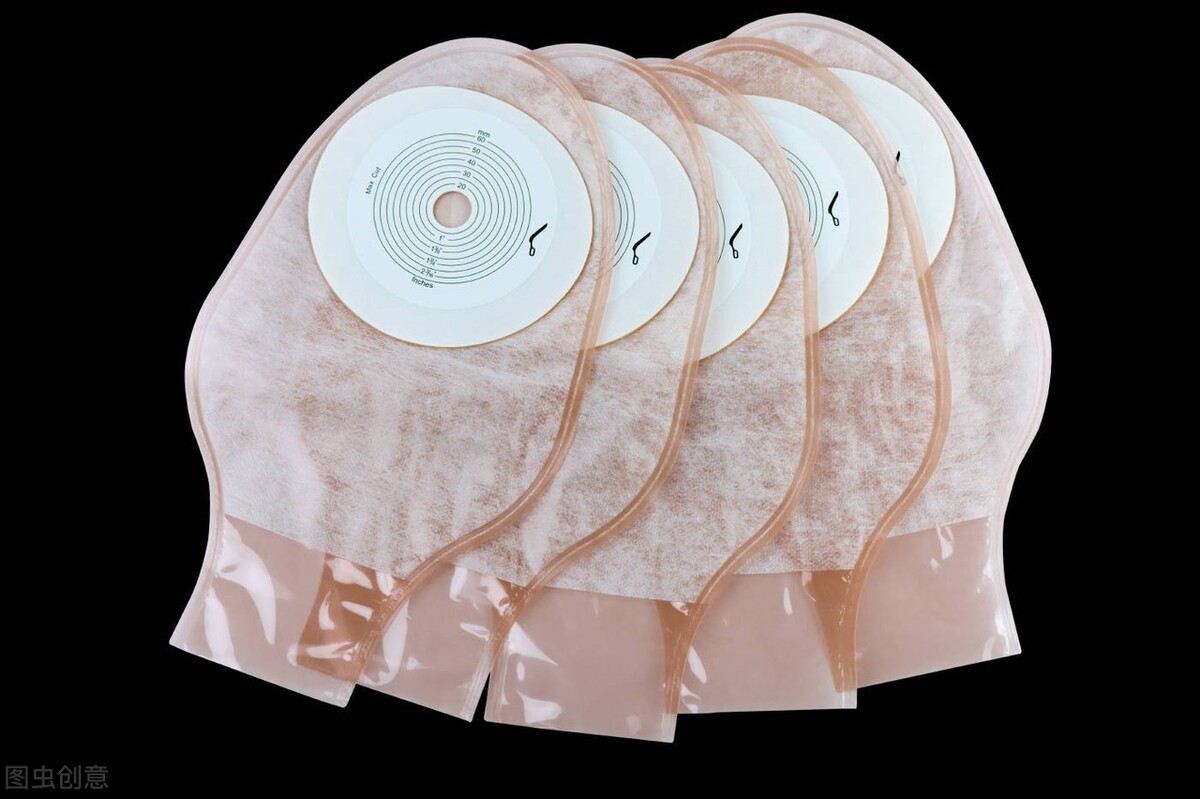 造口患者最要注意的是什么,癌症开造口是什么意思