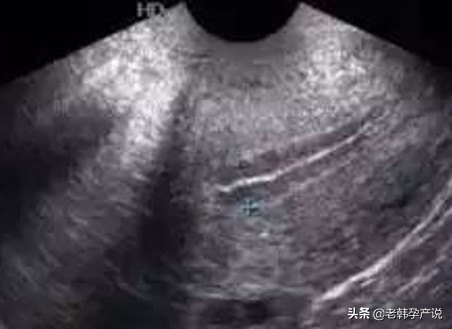 中医治疗子宫内膜薄,子宫内膜薄什么意思