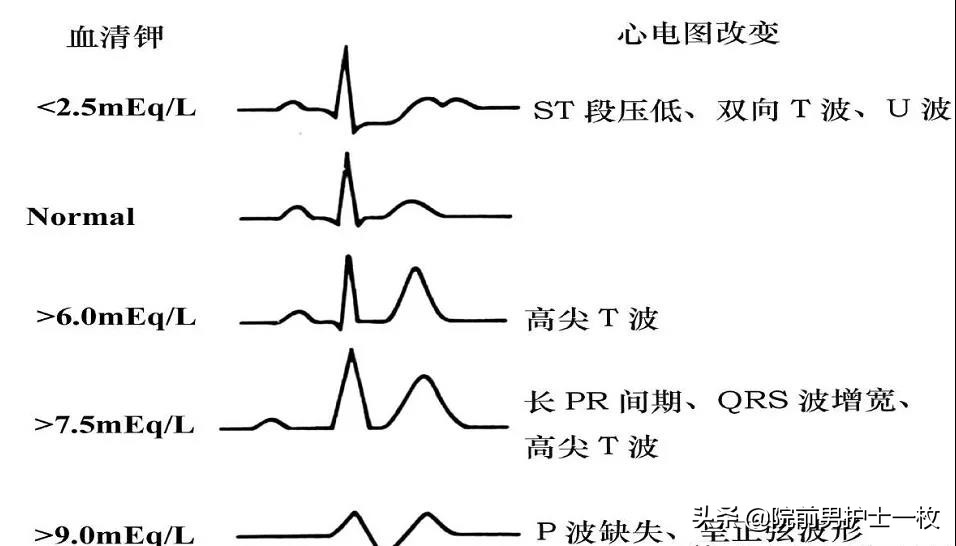 血清钾血清钠血清氯都升高,血清钾高的表现及危害