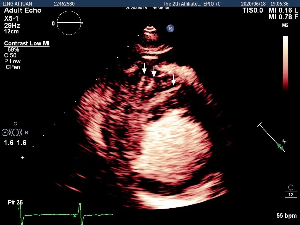肥厚型非梗阻心肌病吃什么中药,肥厚心肌病非梗阻最新治疗方案