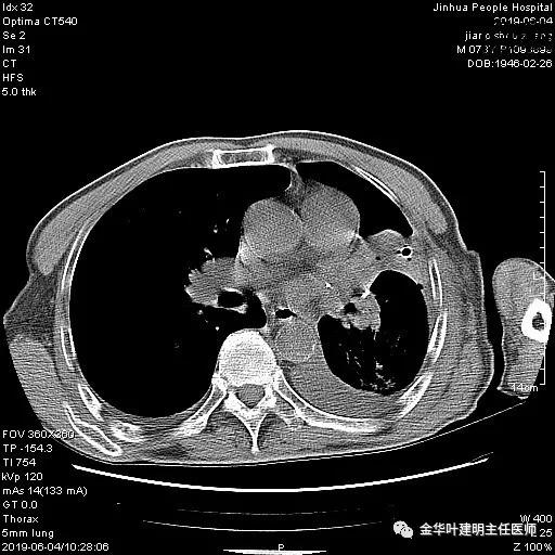 肺手术后乳糜胸是医疗事故吗,肺部切除后乳糜胸治好了