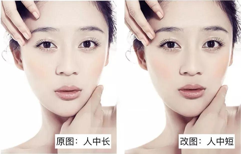 人中太短可以加长整形吗,人中过长有必要缩短吗