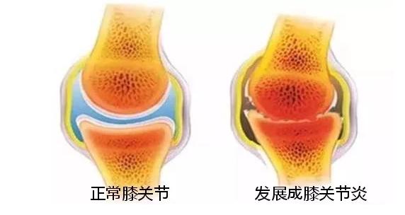 退行性关节炎怎样治疗好得快,退行性关节炎怎么治疗最好