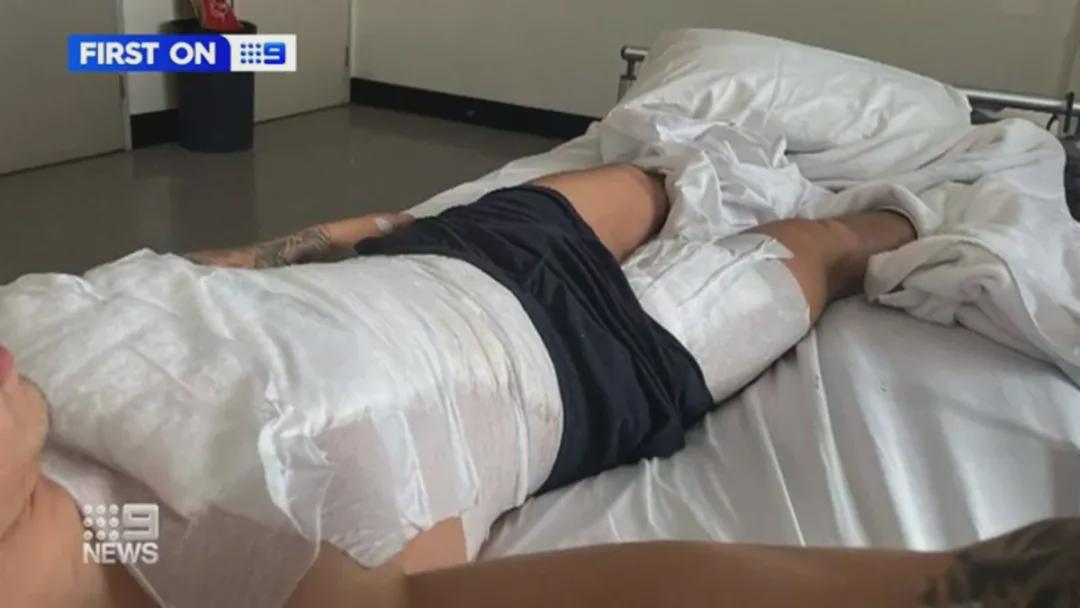 热水袋低温烫伤造成截肢,热水袋烫伤植皮疼吗