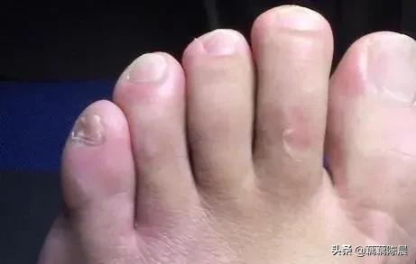 艾灸治脚气的最佳方法,艾灸治脚气效果好吗