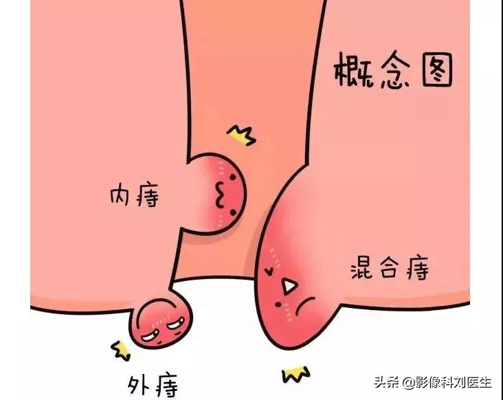 十人九痔怎么治疗好得快,十人九痔痔疮究竟是怎么回事