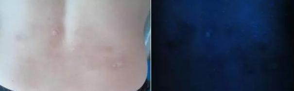 喝酒导致白癜风扩散,喝酒导致白癜风严重