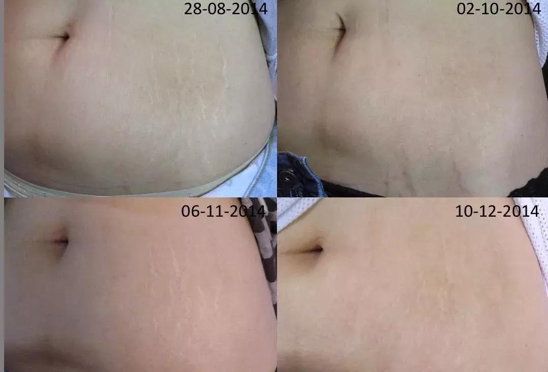 生完孩子变漂亮了,生完孩子反而变美了